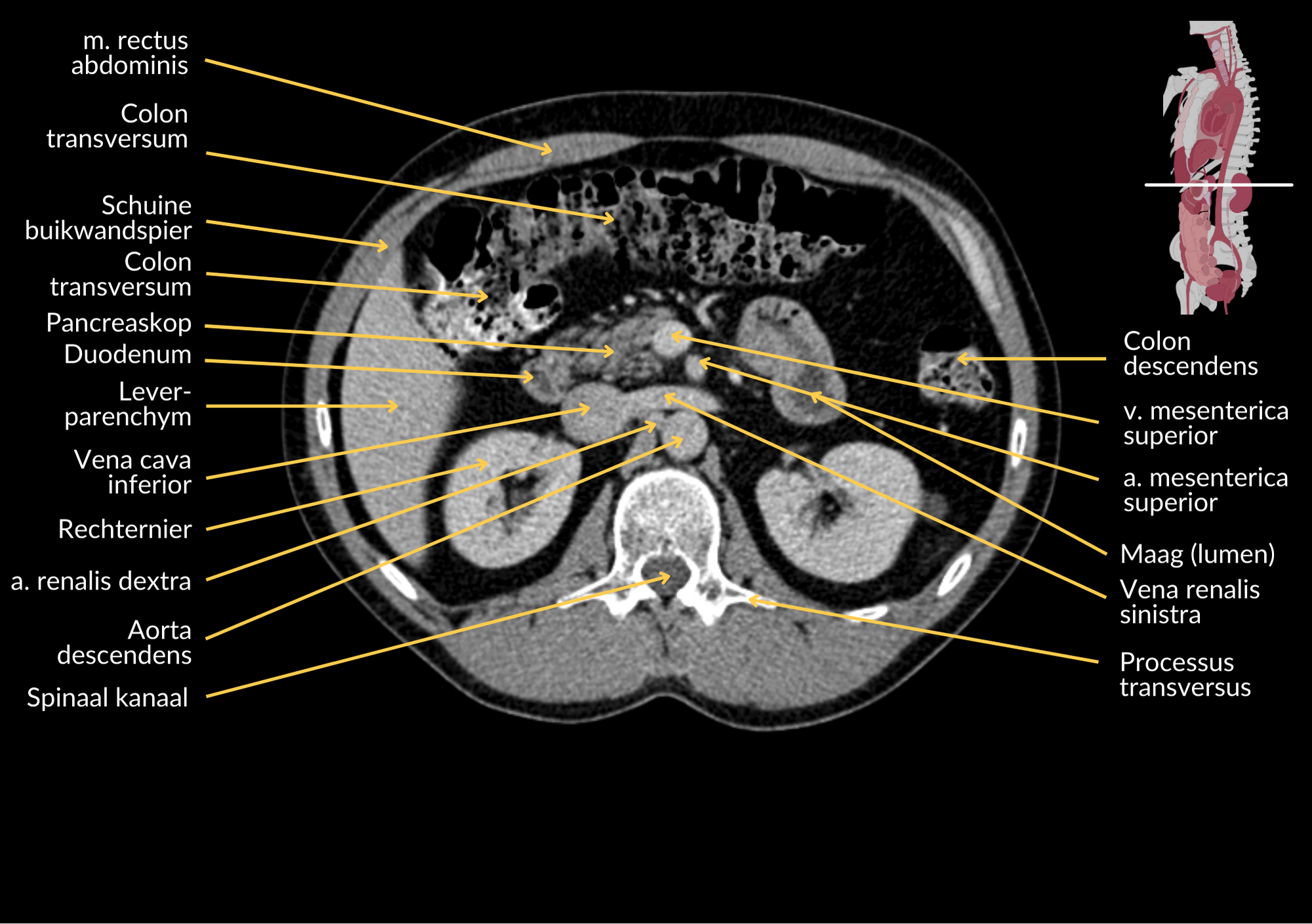 Radiologisch beeld 10 met annotaties
