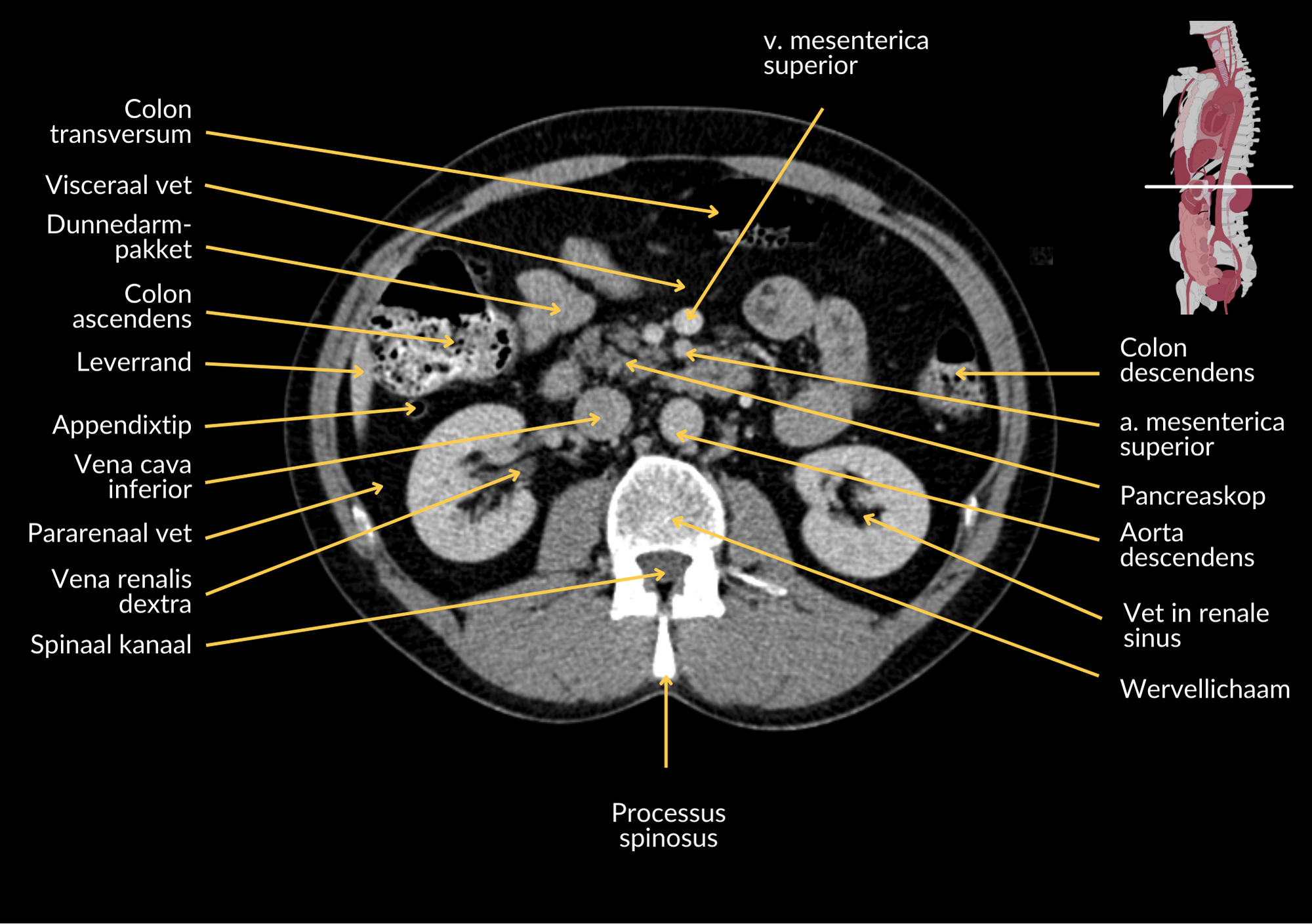 Radiologisch beeld 11 met annotaties