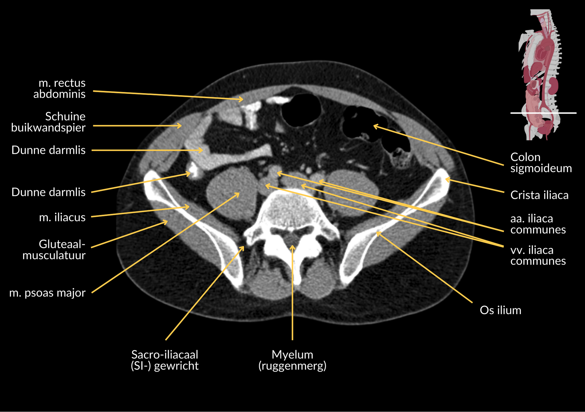Radiologisch beeld 12 met annotaties