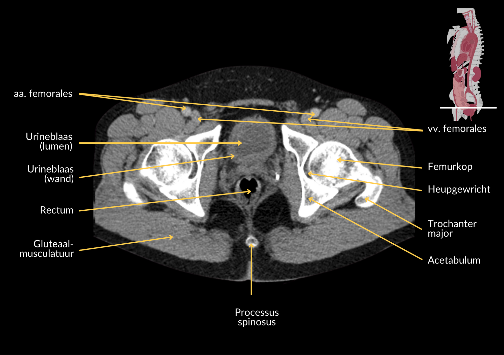 Radiologisch beeld 13 met annotaties