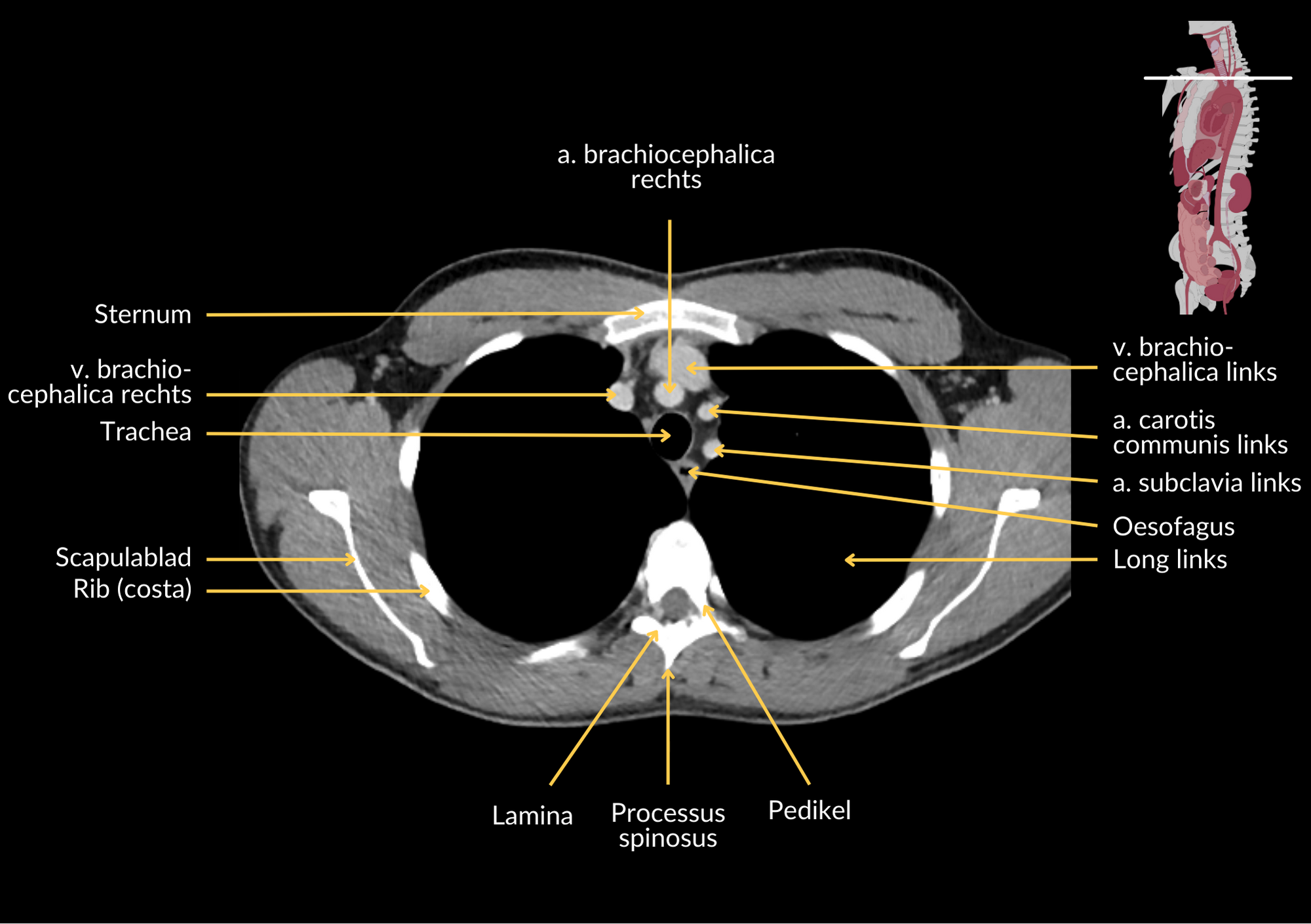 Radiologisch beeld 2 met annotaties