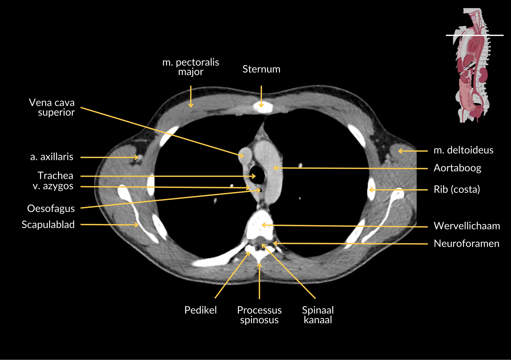 Radiologisch beeld 3 met annotaties