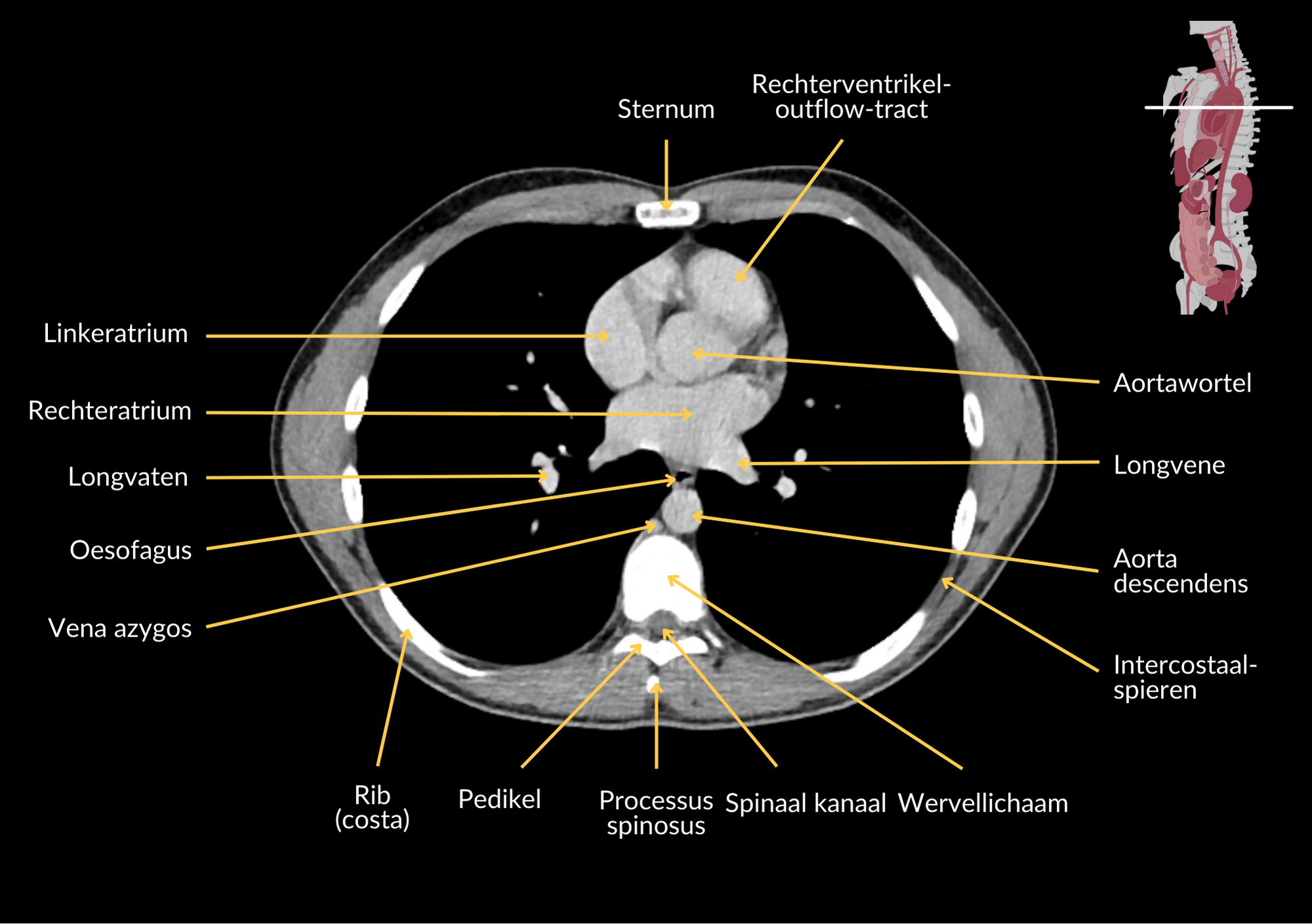 Radiologisch beeld 5 met annotaties