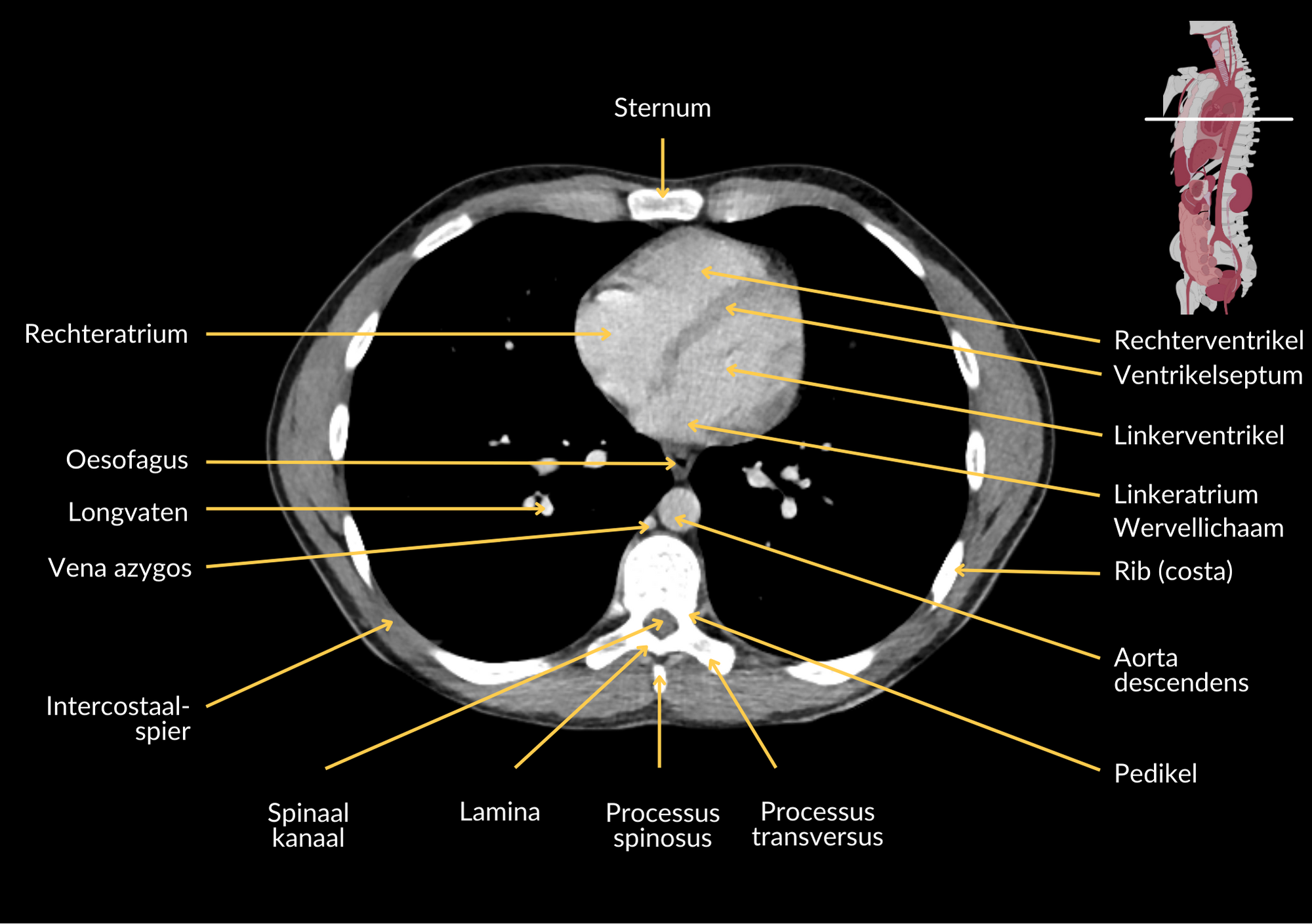 Radiologisch beeld 6 met annotaties