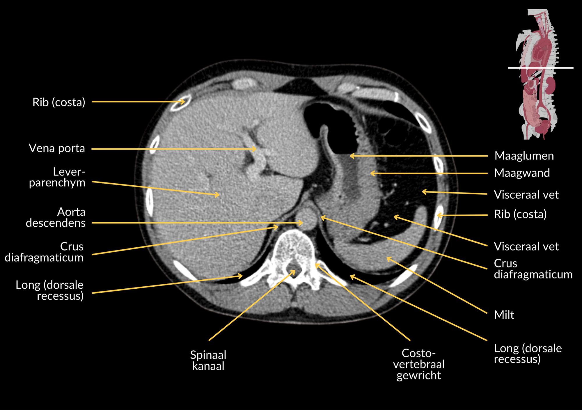 Radiologisch beeld 7 met annotaties