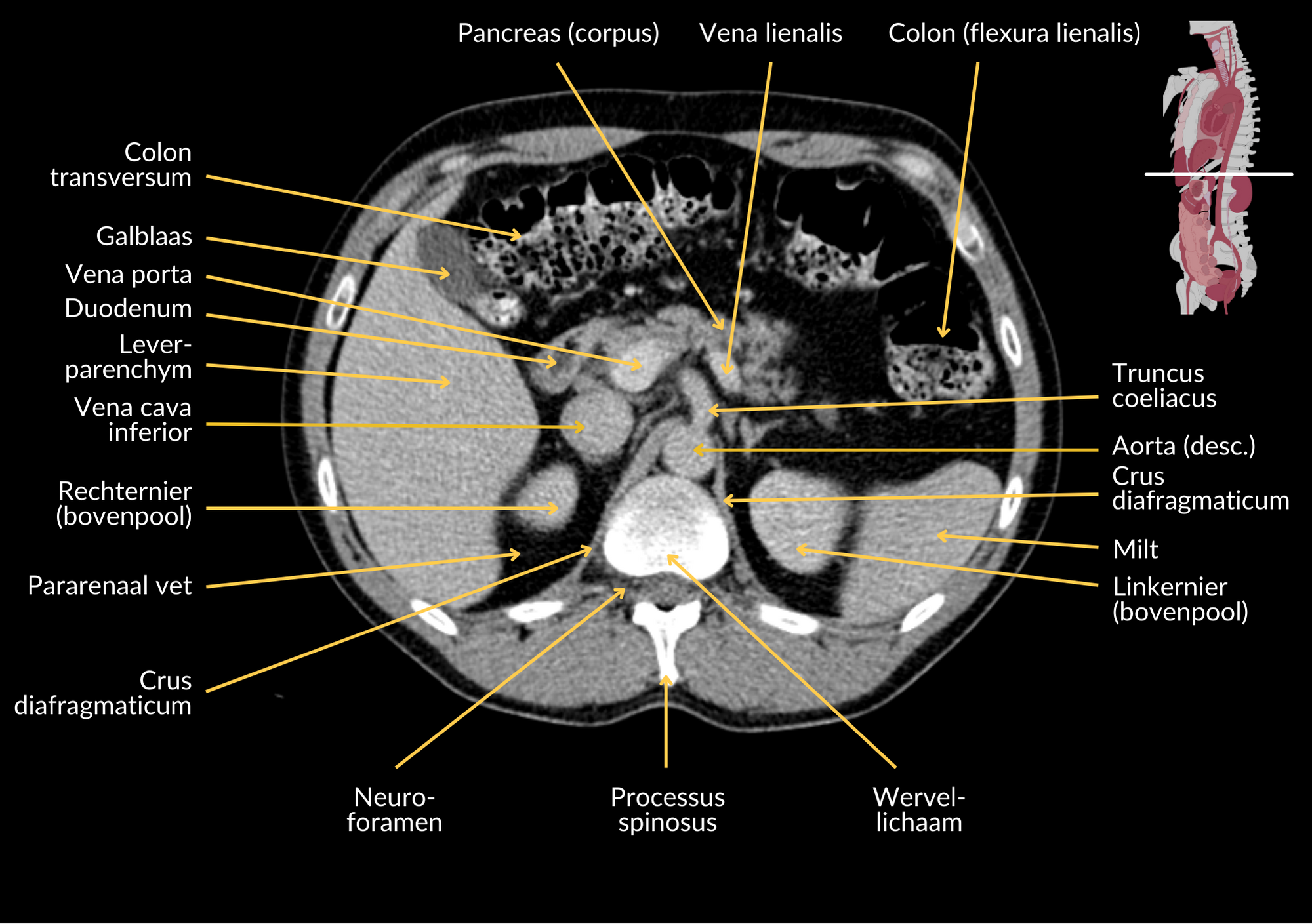 Radiologisch beeld 9 met annotaties